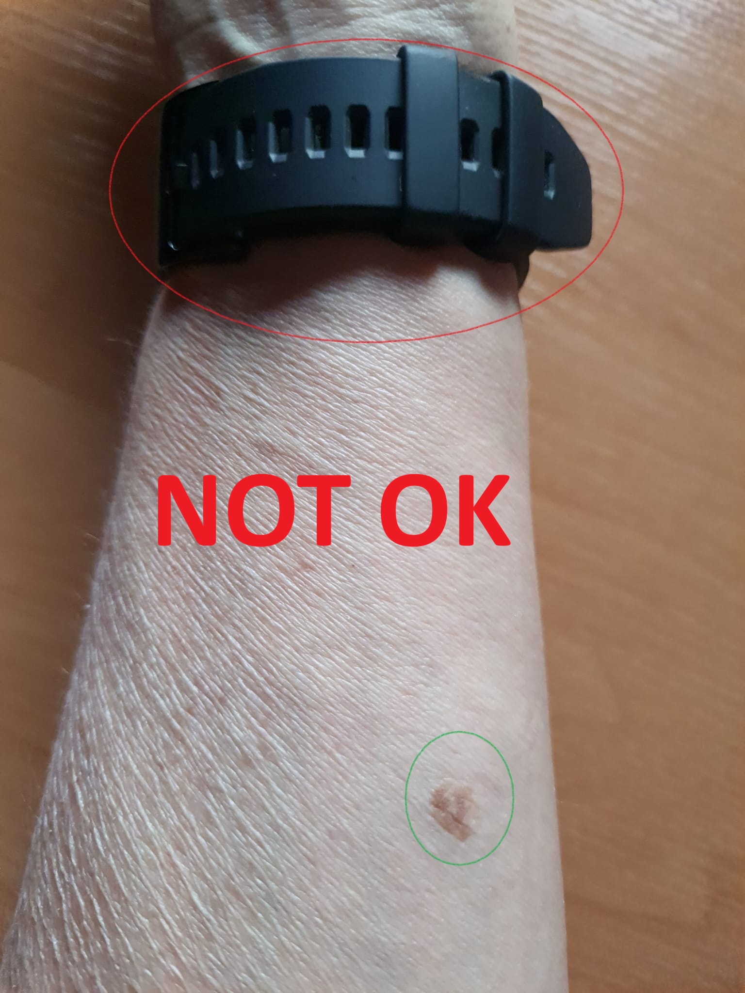 Bad mole photo example